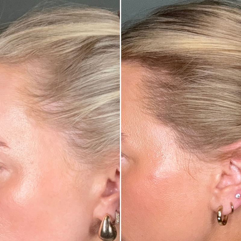 Tutto Quello Che Devi Sapere Sulla Caduta Dei Capelli Nelle Donne