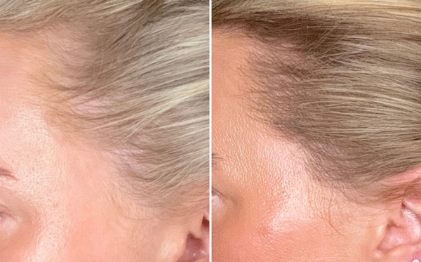 Tutto Quello Che Devi Sapere Sulla Caduta Dei Capelli Nelle Donne