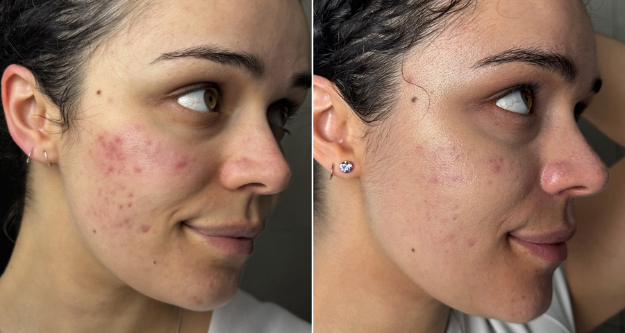 Terapia con luce LED rossa prima e dopo: immagini e risultati