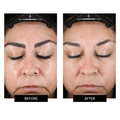 NuFACE TRINITY+ Dispositivo Tonificante e Testina Riduzione Rughe