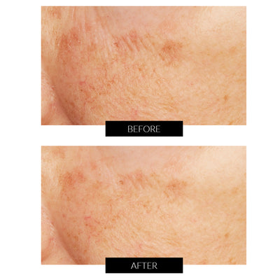 Acid Peel al Limone Caviale con Acido Glicolico Lancer (50ml)