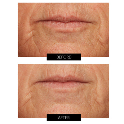 Lancer Skincare Pro Polish - Dispositivo di Microdermoabrasione