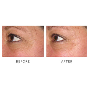 Silk'n Facetite & Silk'n Infinity 400,000 Kit