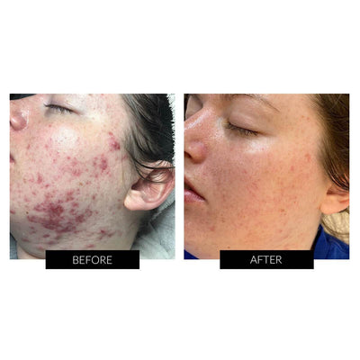 Dermalux Flex MD
