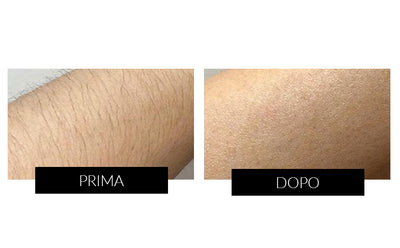 Dispositivo di Epilazione IPL & Antietà Ulike Rose