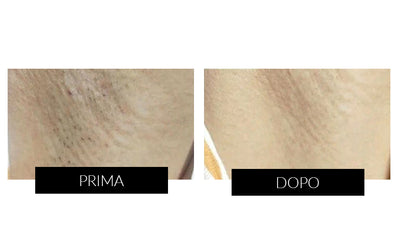 Dispositivo di Epilazione IPL & Antietà Ulike Rose