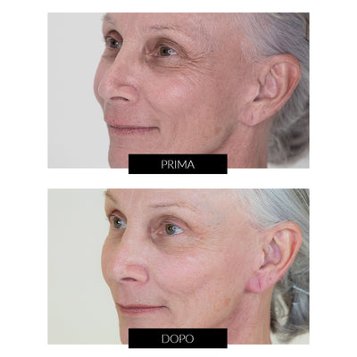 NIRA Pro Skincare Laser - CurrentBody Exclusive