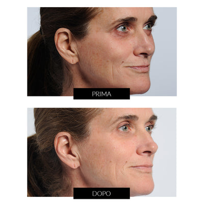 NIRA Pro Skincare Laser - CurrentBody Exclusive