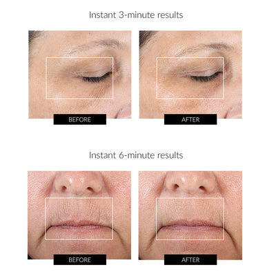 Regimen NuFACE Fix Line Smoothing Limited-Edition