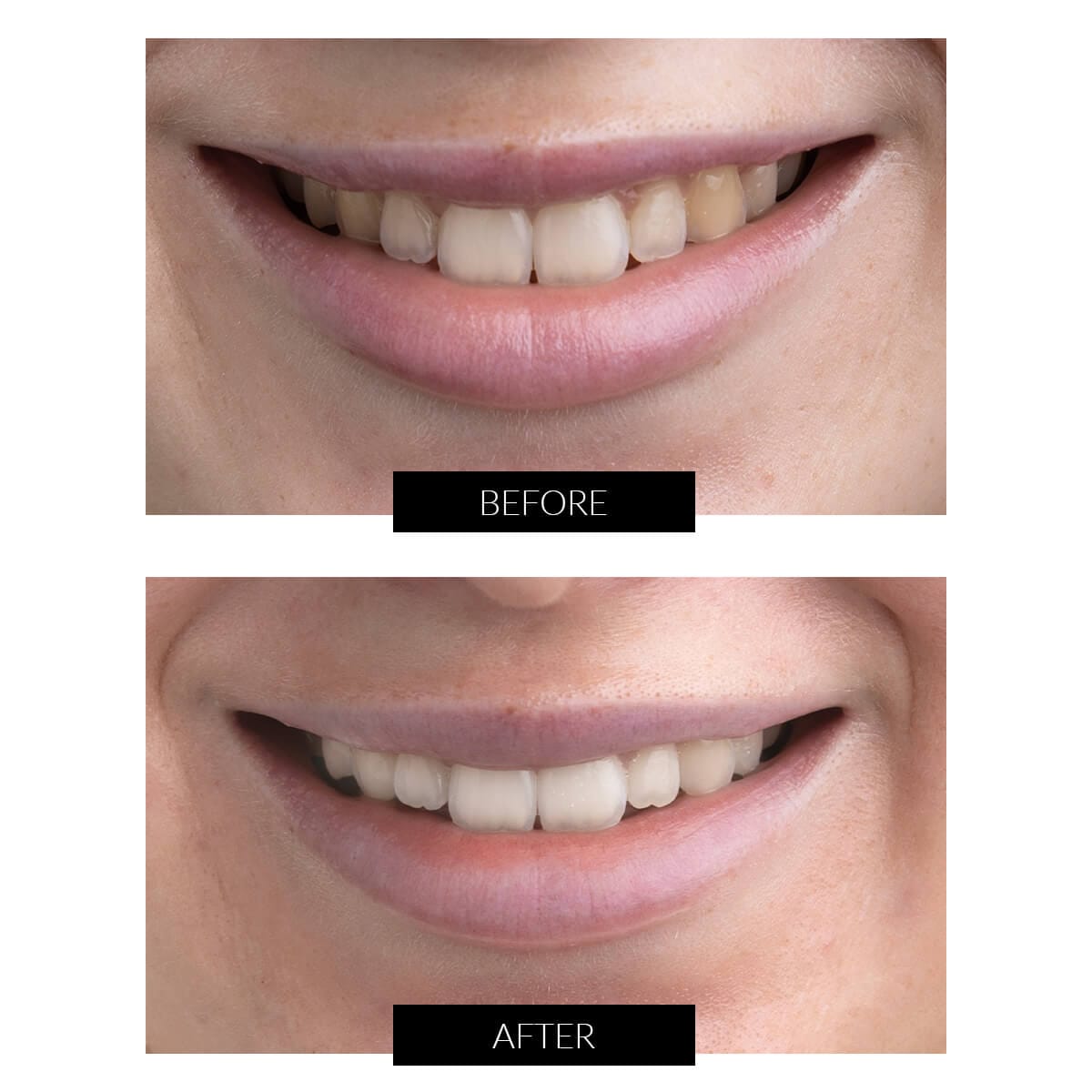 TEETHWHITENING-